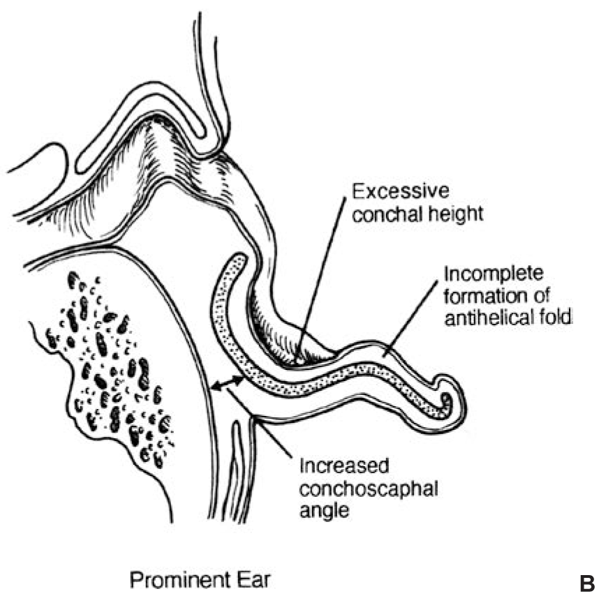 prominent ear