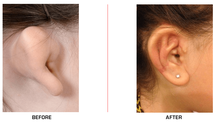 Ear Reconstruction before after case1