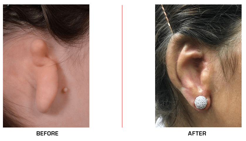 Ear Reconstruction before after case6