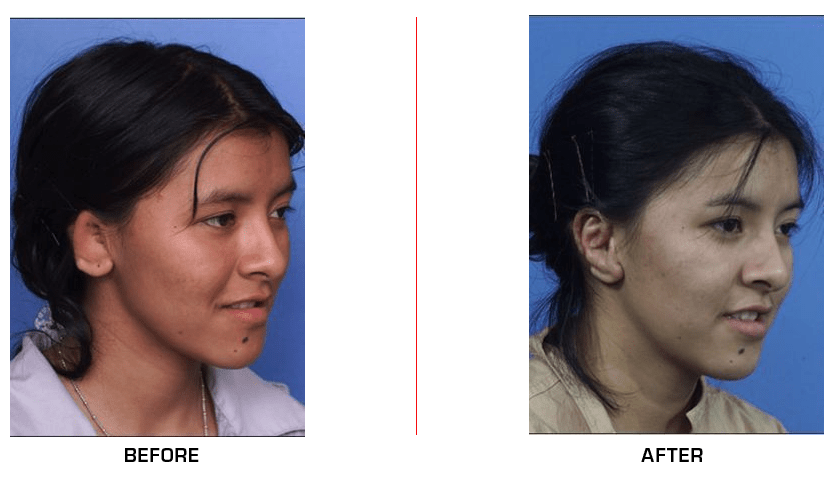 Ear Reconstruction before after case7