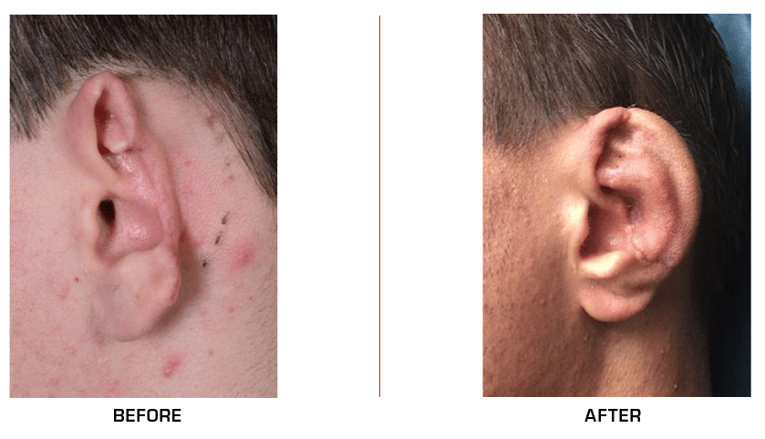 Ear Reconstruction before after case9