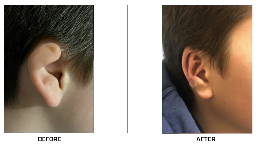 Ear Reconstruction before after case12