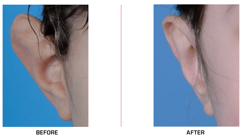 otoplasty before after case3