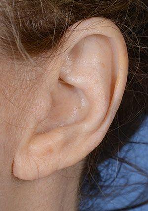 earlobe shortening before